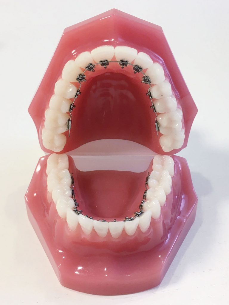 Les appareils dentaires fixes Dr Cabrol